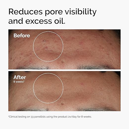 THE ORDINARY Blemish Control & Oil Balancing Serum 30 ml